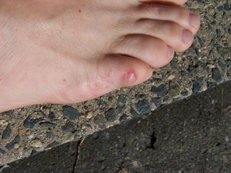 Biran's Toe.